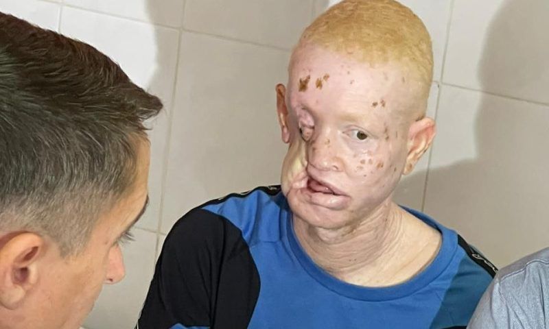 Хирурги краснодарской БСМП восстановили лицо темнокожему альбиносу из Сенегала